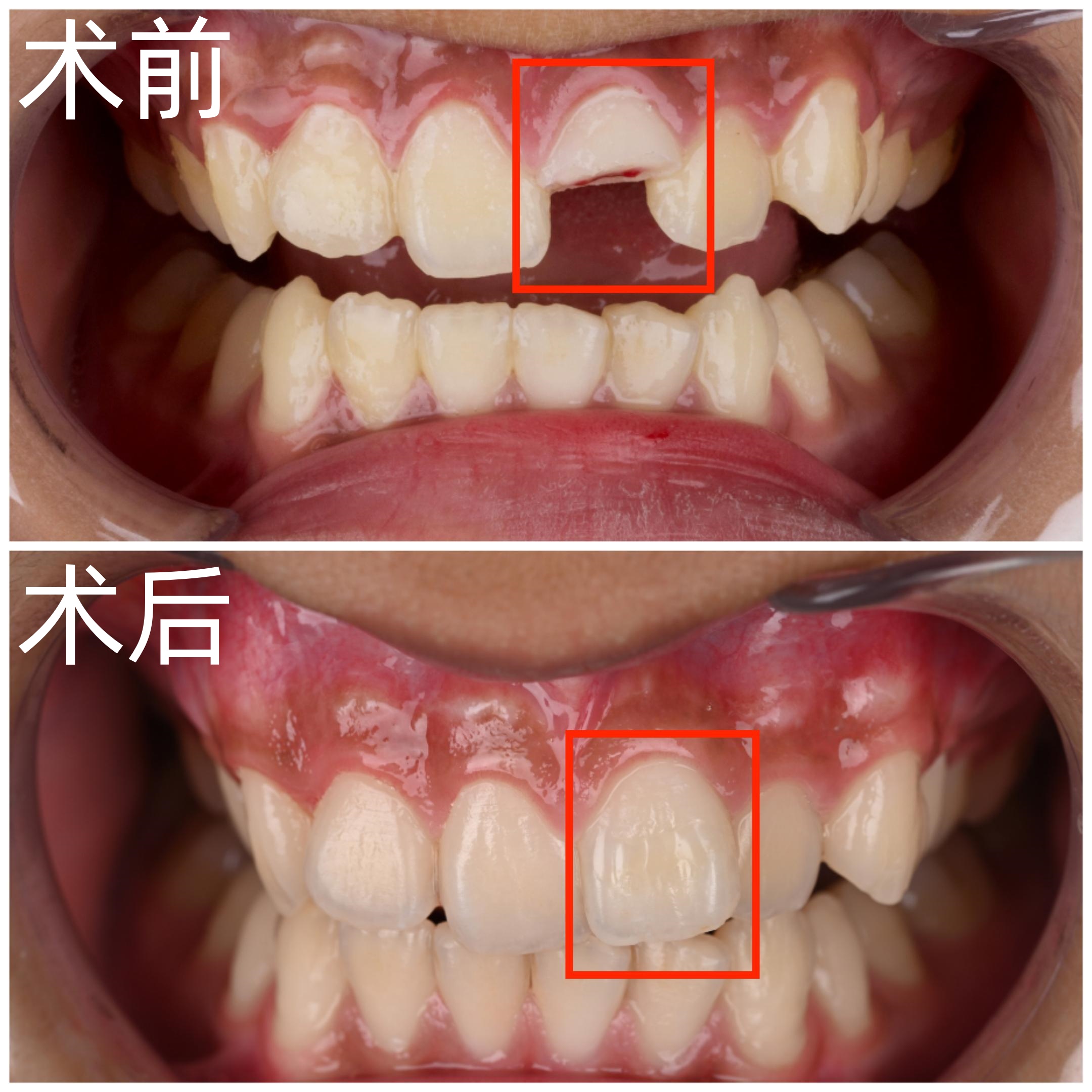 断牙修复