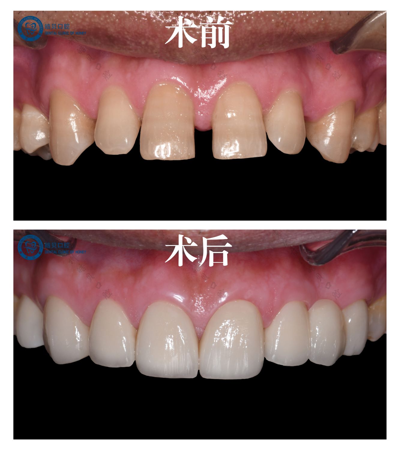 全瓷冠美学修复关闭牙间隙